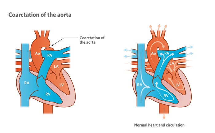 Illustration of a heart with coarctation of the aorta vs normal heart circulation.