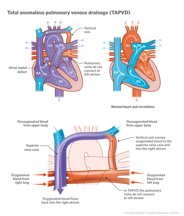 Illustration of total anomalous pulmonary venous drainage circulation vs normal heart circulation