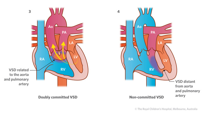 Illustration of heart with doubly committed VSD and non-committed VSD