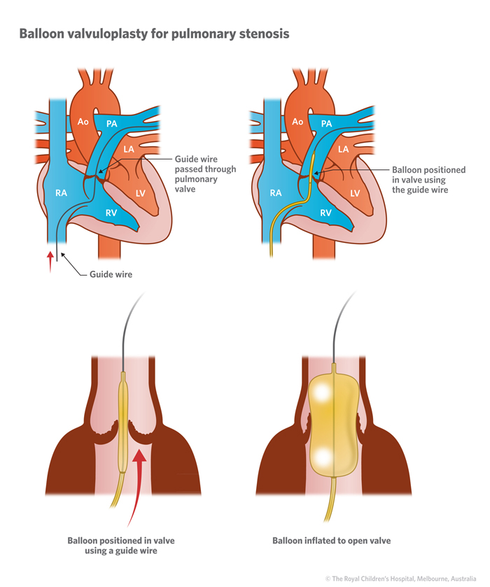 Illustration of heart with balloon valvuloplasty for pulmonary stenosis
