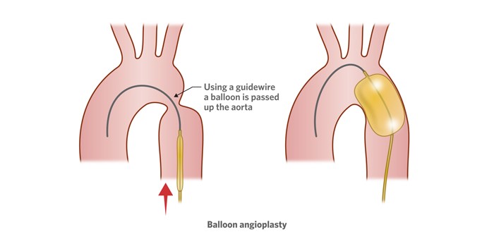 Illustration of a balloon angioplasty treatment