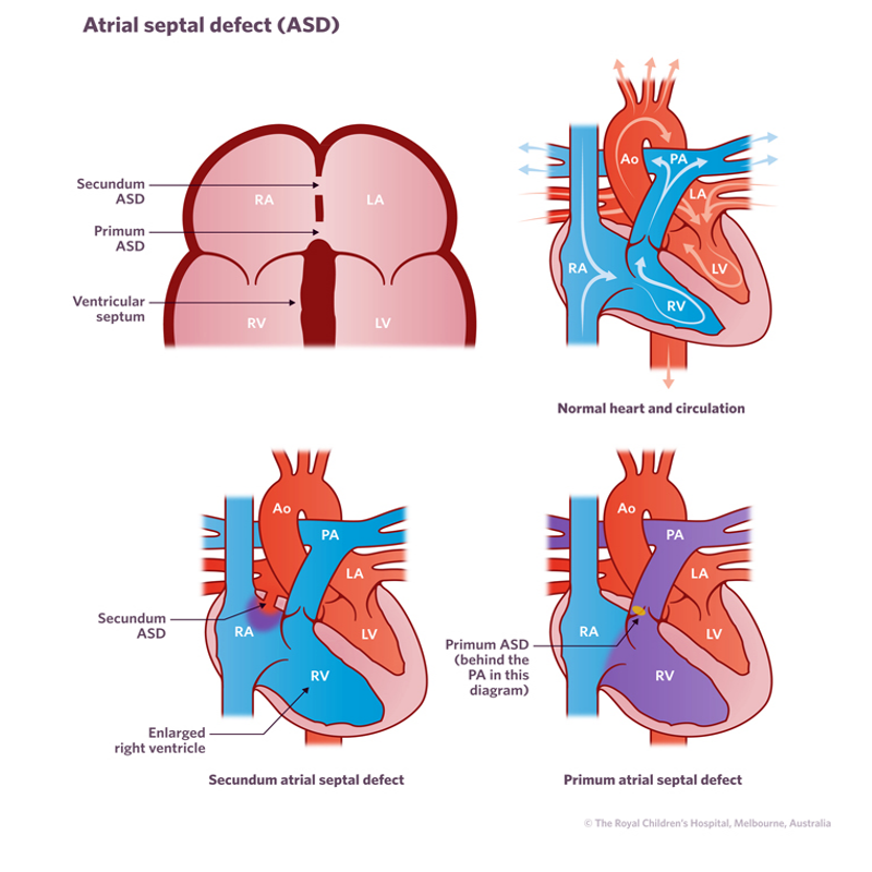 Diagram of normal heart beside hearts showing secundum ASD and primum ASD.