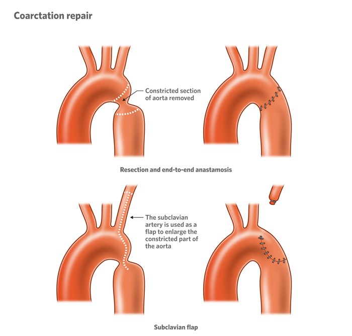 Illustration of how a constricted section of an aorta can be surgically repaired.