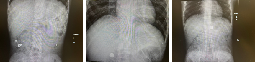 X-rays of magnets, batteries, screws and hardware ingested by children over the past decade at QCH