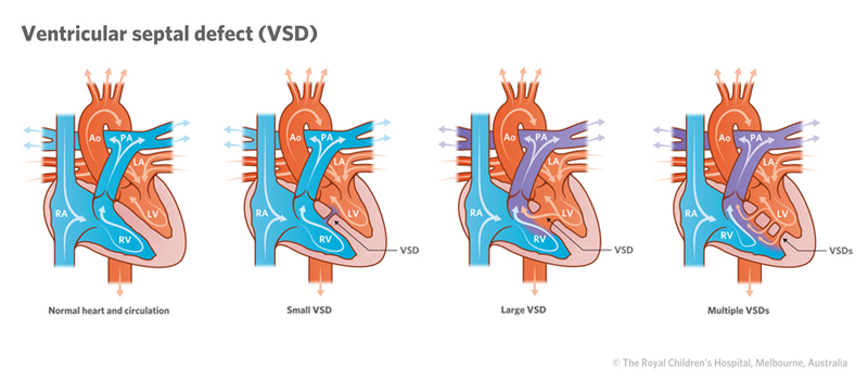 Illustration of hearts with ventricular septal defects