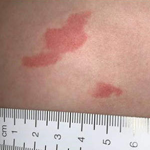 Photo of skin with red patch or welt on it.