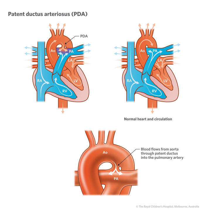 Patent ductus arteriosus illustration