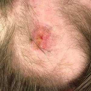 Photo of skin where hte skin has become an open blister or sore.