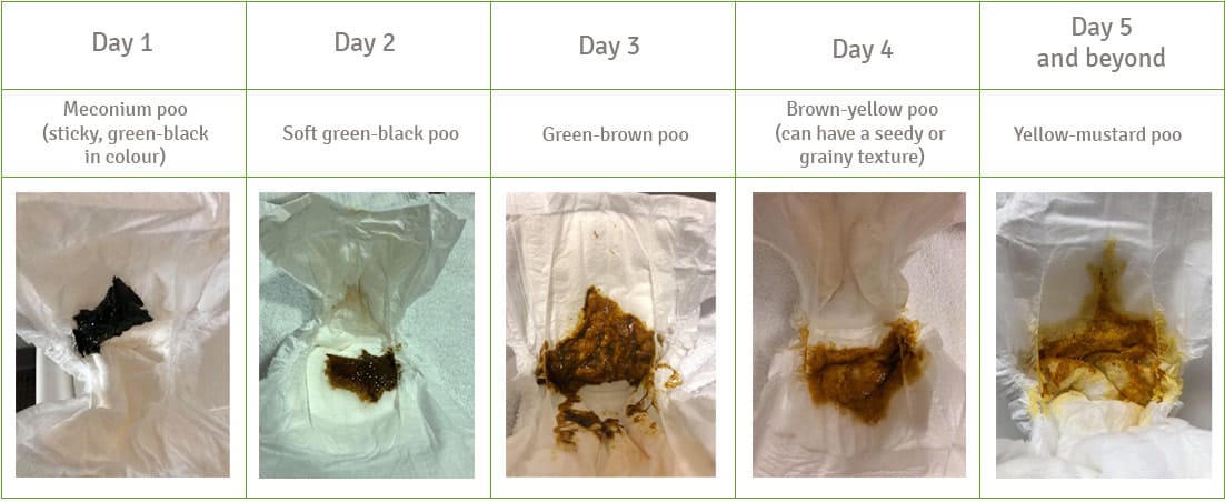 Baby nappies from days 1 to 5. Day 1 - Meconium poo, sticky green-black colour. Day 2 - soft green-black poo. Day 3 - green-brown poo. Day 4 - brown-yellow poo with a seedy or grainy texture. Day 5 - yellow mustard poo.