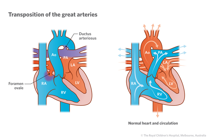 Illustration of transposition of the great arteries (TGA) vs normal heart circulation.