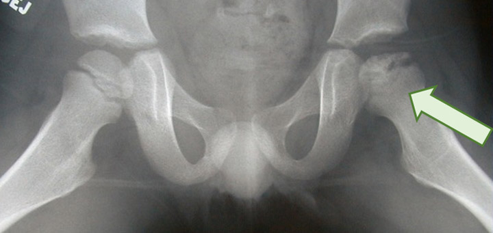 X-ray of hip showing Perthes disease