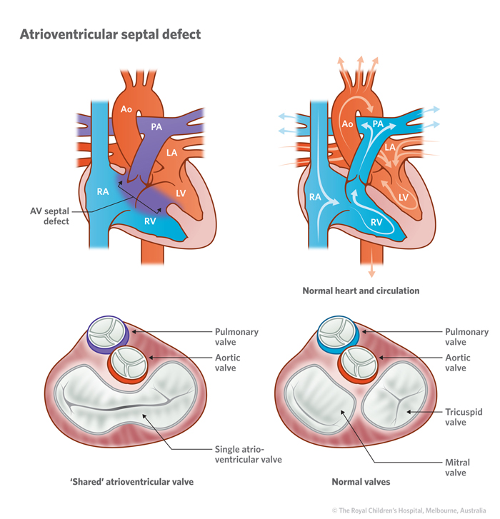 Illustration of an atrioventricular Septal Defect (AVSD) vs normal heart circulation
