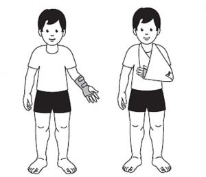 A splint cover is worn on the wrist and lower arm. It can be supported by a sling that hangs from the neck.