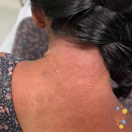 Eczema on back of child aged over 12 years