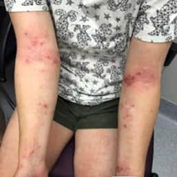 Eczema on arms of child aged over 12 years