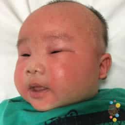 Eczema on face of child aged birth to 6 months