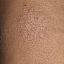 Eczema on skin of child aged over 12 years