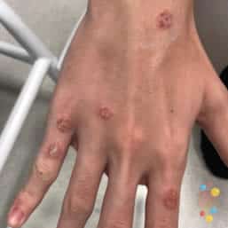 Nummular eczema on hand of child