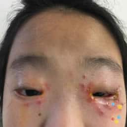 Eczema herpeticum on eye of child
