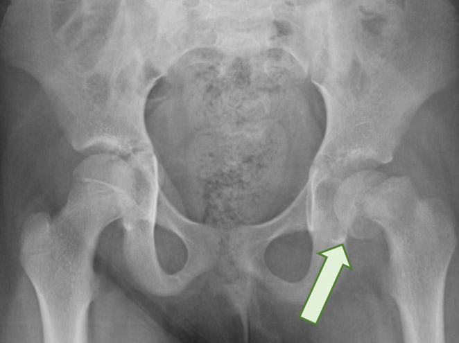 X-ray of hip showing Slipped Upper Femoral Epiphysis (SUFE)