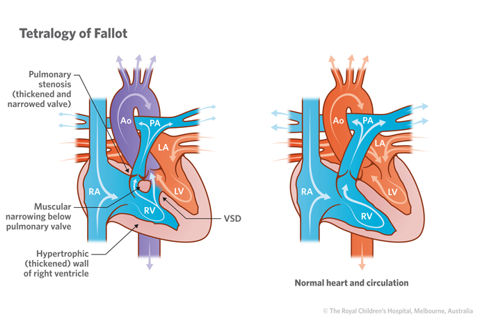 Illustration of tetralogy of Fallot vs normal heart circulation