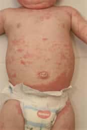 Eczema on body of child aged birth to 6 months
