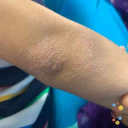 Eczema papules on elbow of child