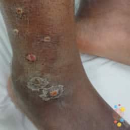 Nummular eczema on foot of child