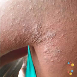 Eczema papules on shoulder of child