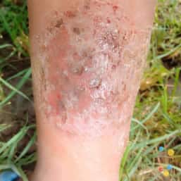 Nummular eczema on leg of child