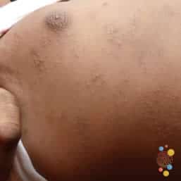 Eczema papules on chest of child
