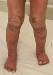 Eczema on legs of child aged 6 months to 12 years