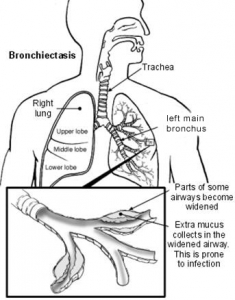The trachea allows air to be breathed down the throat and into each lung which has upper, middle and lower lobes. If some parts of the bronchial airways widen, extra mucus collects which can cause infection.