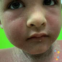 Impetiginised eczema on face of child