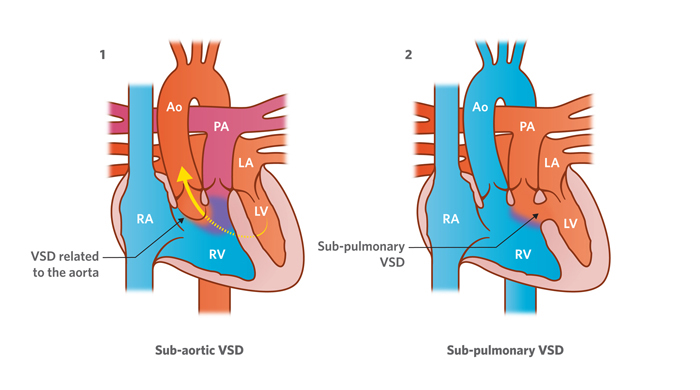 Illustration of heart with sub-aortic VSD and sub-pulmonary VSD
